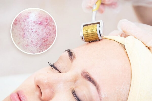 Lăn kim là phương pháp được dùng nhiều trong việc se khít lỗ chân lông, điều trị da