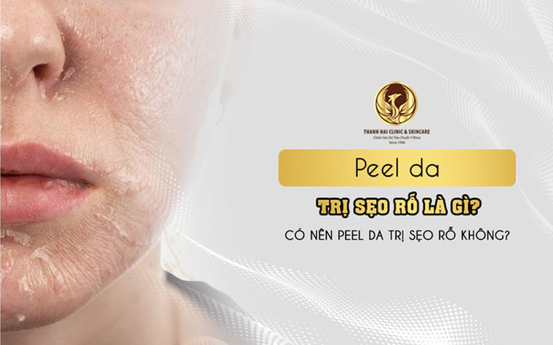 Peel da trị sẹo rỗ là gì? Có nên peel da trị sẹo rỗ không?