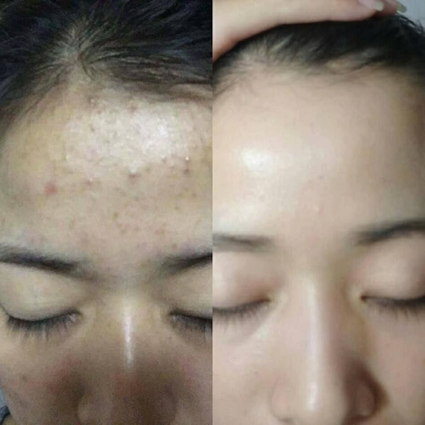 Chị Oanh Vy Trần sử dụng sản phẩm kết hợp thêm phương pháp điều trị công nghệ cao