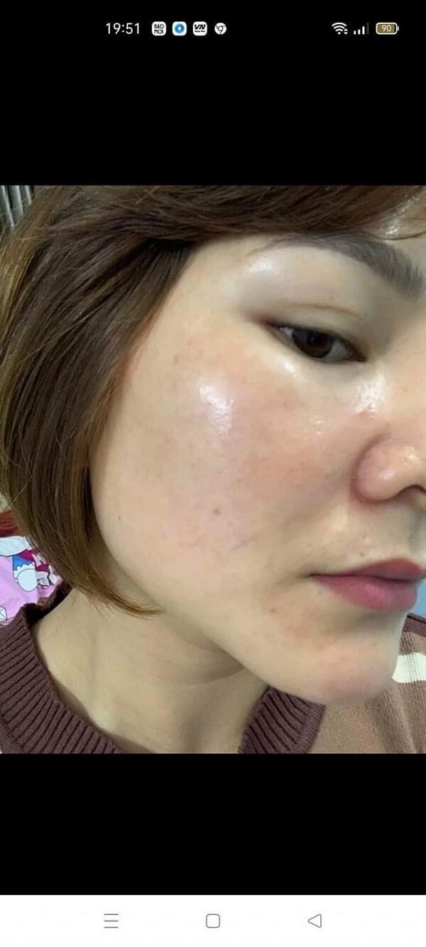 Da mặt chị Như Ngọc đã dần ổn định và khỏe hơn sau khi dùng Murad Rapid Collagen Infusion