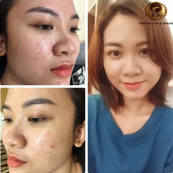 Khách hàng điều trị mụn thành công tại Thanh Hải Khách hàng điều trị mụn thành công tại Thanh Hải