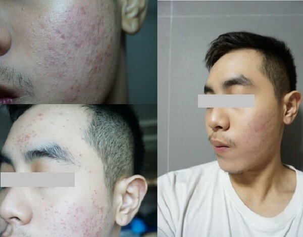 Da mụn viêm nặng của Kiên cải thiện 70% sau khi kiên trì sử dụng Da mụn viêm nặng của Kiên cải thiện 70% sau khi kiên trì sử dụng