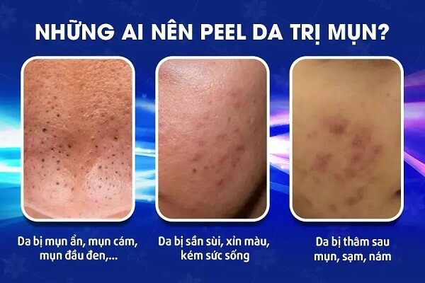 Đây là những tình trạng da được thực hiện phương pháp Peel da