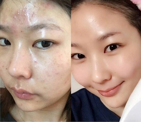 Làn da mụn viêm của chị Thùy Dung chỉ sau 1 tháng sử dụng