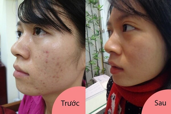Phải kết hợp thêm việc điều trị tại các Spa da mặt chị Mai mới được cải thiện