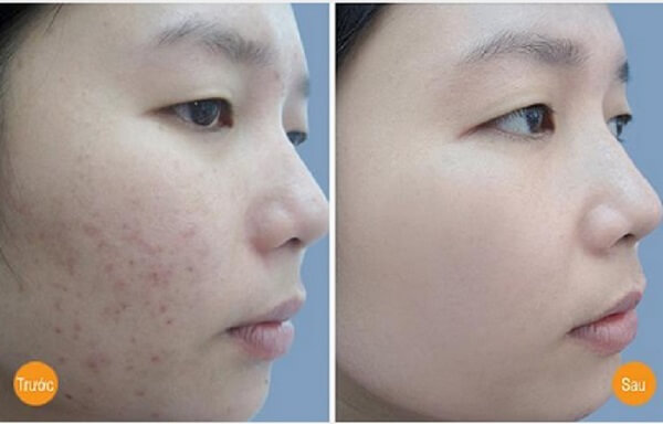 Tình trạng mụn của chị Thủy chỉ sau 1 tháng sử dụng sản phẩm Tình trạng mụn của chị Thủy chỉ sau 1 tháng sử dụng sản phẩm