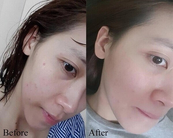 Bạn Thanh Trang chia sẻ về kem trị mụn Nhật Bản Bạn Thanh Trang chia sẻ về kem trị mụn Nhật Bản