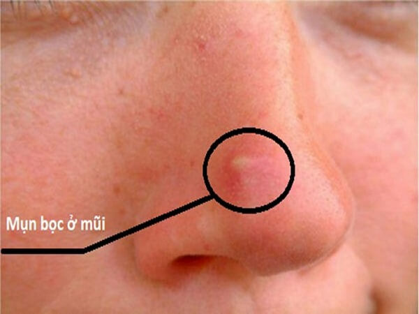 Nguyên nhân gây nổi mụn trên mũi