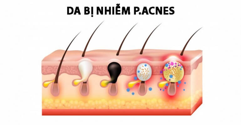Vi khuẩn gây mụn P.acnes
