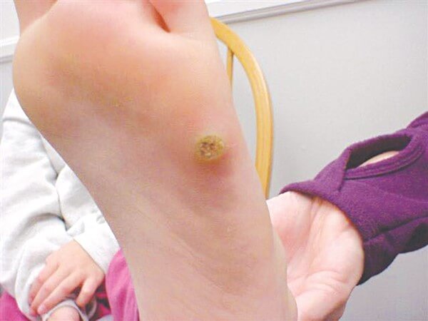 Mụn cóc ở chân là tình trạng phổ biến ở nhiều người