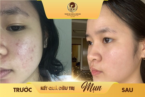 Kết quả điều trị mụn tại Thanh Hải Clinic & Skincare
