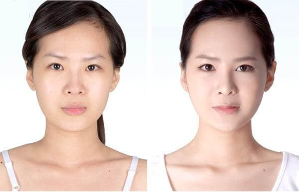 Sự khác biệt trước và sau phi kim tái tạo trẻ hóa da