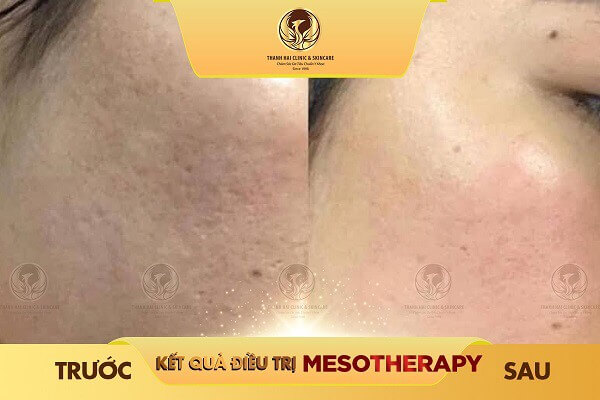 Cải thiện làn da chỉ sau một liệu trình điều trị tại Thanh Hải Clinic & Skincare