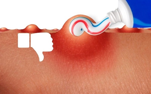 Dùng kem đánh răng thông thường là cách trị mụn đơn giản