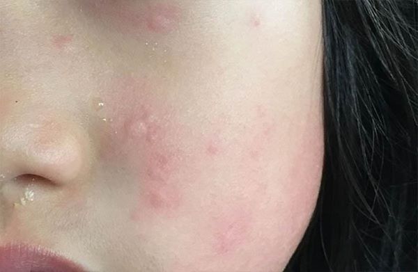 Cận mặt làn da của chị Ngọc Duy sau khoảng 1 tuần sử dụng Dermalogica Special Cleansing Gel